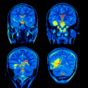 Resonancia magnética funcional