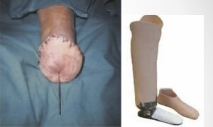 Nuevo método de amputación