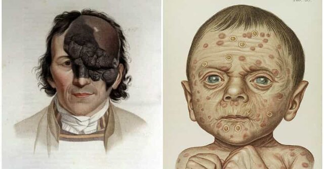 Tuskeegee Syphillis Study