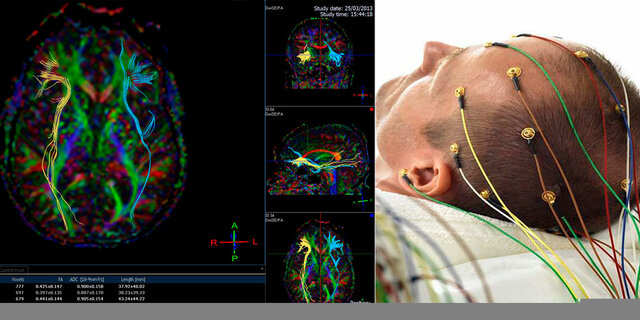 Electroencefalografía
