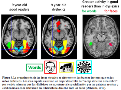 fMRI (imágenes de resonancia magnética funcional) para mostrar como funcionan los cerebros de los niños con dislexia