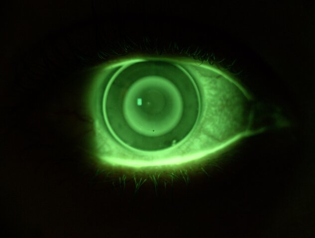 La FDA aprueba la ortoqueratología