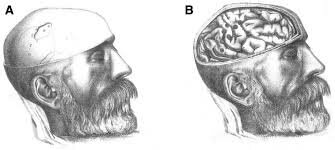 Roberts Bartholow 1874