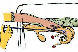 Inseminación artificial