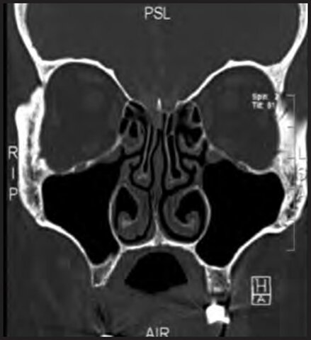 Galeno y el Líquido cefalorraquídeo