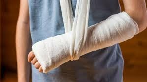 Fractura de brazo izquierdo