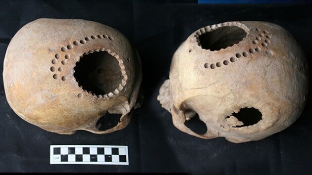 Trepanación (2,500,000 a. C - 3,500 a. C)