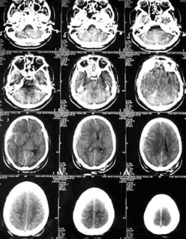 Asimismo, surge un nuevo modelo en la interpretación de la organización cerebral de la cognición, el denominado “modelo funcional”. Hasta este momento se había utilizado un “modelo lesional”.
