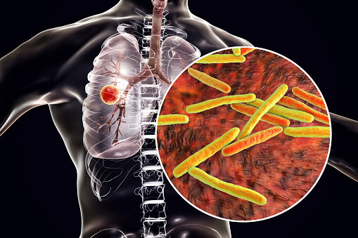 ¡La tuberculosis no es hereditaria!