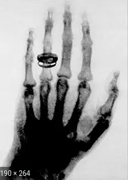Wilhem roentgen discovers Xrays