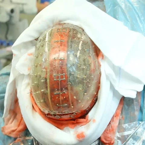 Skull Transplant