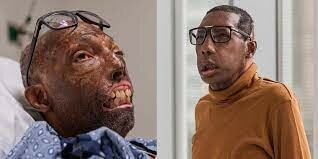 First Face Transplant