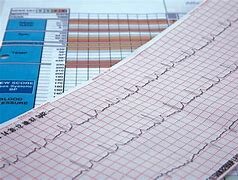 Invención del Electrocardiograma.
