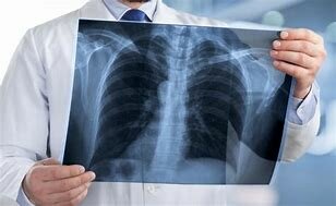 Primera victima con lesiones de radiacion