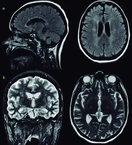 Desarrollo del primer tomografo de rayos X