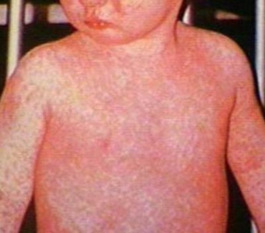 The first measles vaccine licensed.
