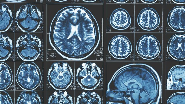 Damadian y Lautelar producen la primera imagen de resonancia magnética.