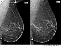 APLICACIONES DESDE 1895 HASTA NUESTROS DÍAS DE LA RADIACIÓN IONIZANTE EN TERAPIA