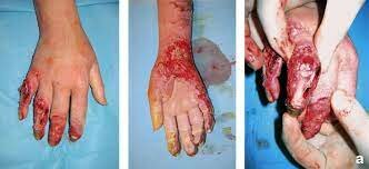 EFECTOS BIOLÓGICOS DE LA RADIACIÓN