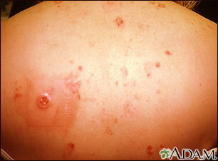 cáncer producido por la exposición a la radiación