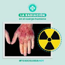 Efectos agudos de la radiación