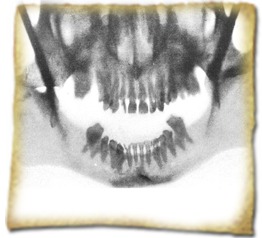 Primera radiografia dental