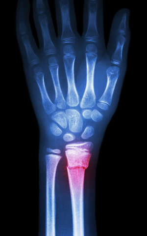 a fall and a fractured wrist