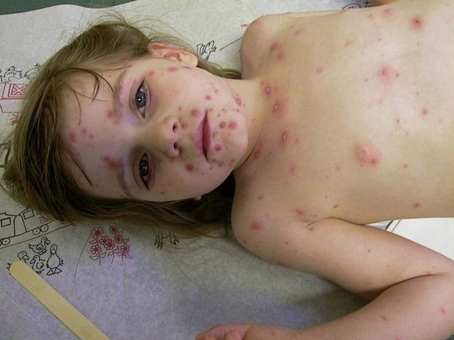 Chicken Pox