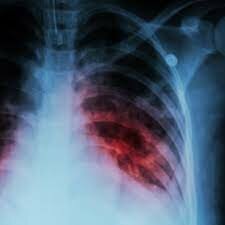 Multi drug tuberculosis treatment
