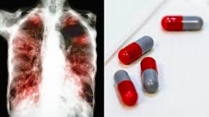 Multi-drug resistant TB treatment