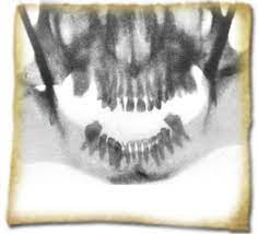 Radiografía Dental