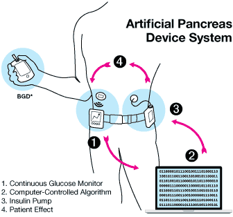 Artificial Pancreas
