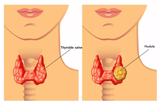 Nous avons appris que ma mère avait le cancer🤍