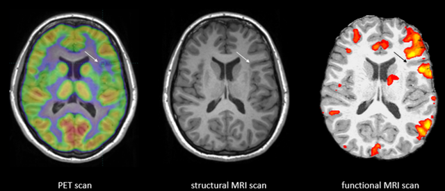 MRI and fMRI