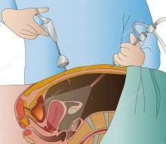 Laparoscopic Surgery