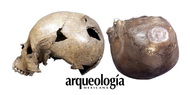 Trepanaciones de cráneo