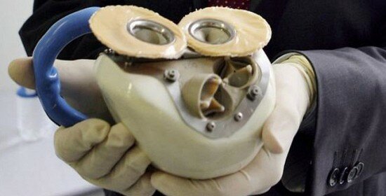 Primer trasplantament d'un cor artificial en un humà en l'hospital Georges Pompidou de París