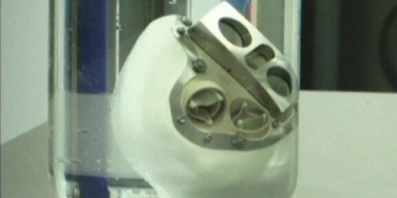 Primer trasplantament d'un cor artificial en un humà a París