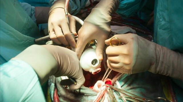 Primer trasplantament d'un cor artificial en un humà.