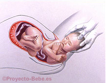 Nacimiento o expulsión