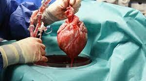 trasplante de corazón entre humanos