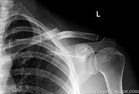 Em trenco el primer os