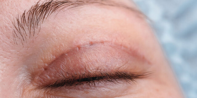Cicatriu a l'ull