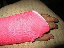 Emily broke a bone for the first time.