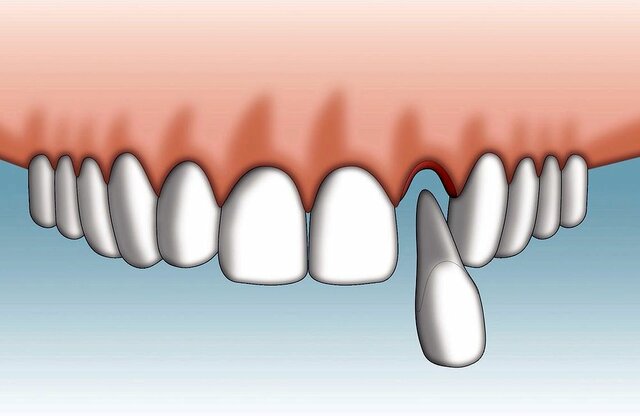 Em cau la primera dent
