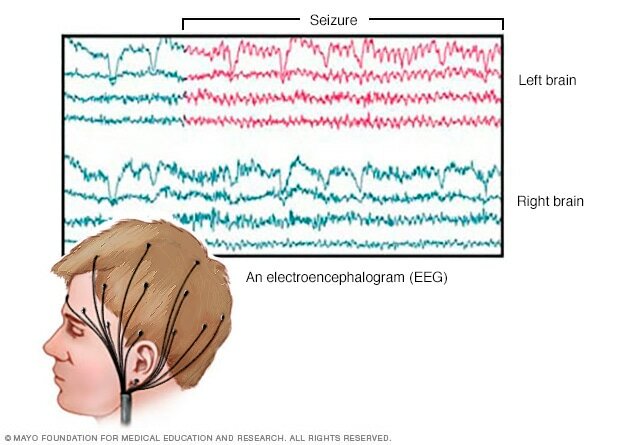 Medical breakthroughs- The Electroencephalogram