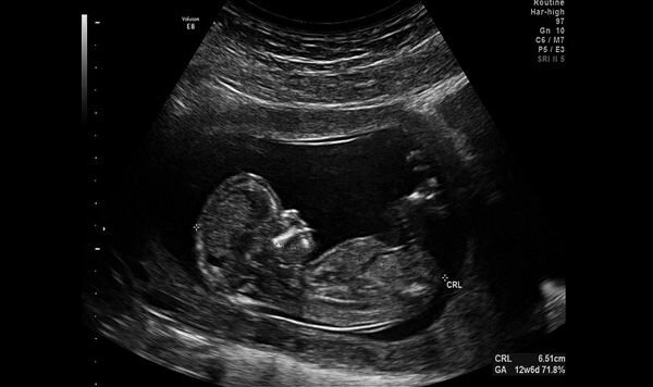 La Ecografía diagnostica