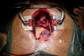 CIRUGÍAS DE CORAZÓN