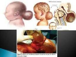 Anormalidades derivadas de los trastornos del cierre del tubo neural