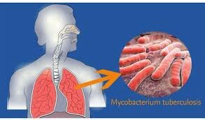 Cᴏɴᴛʀᴏʟ ᴅᴇ ʟᴀ ᴛᴜʙᴇʀᴄᴜʟᴏsɪs.